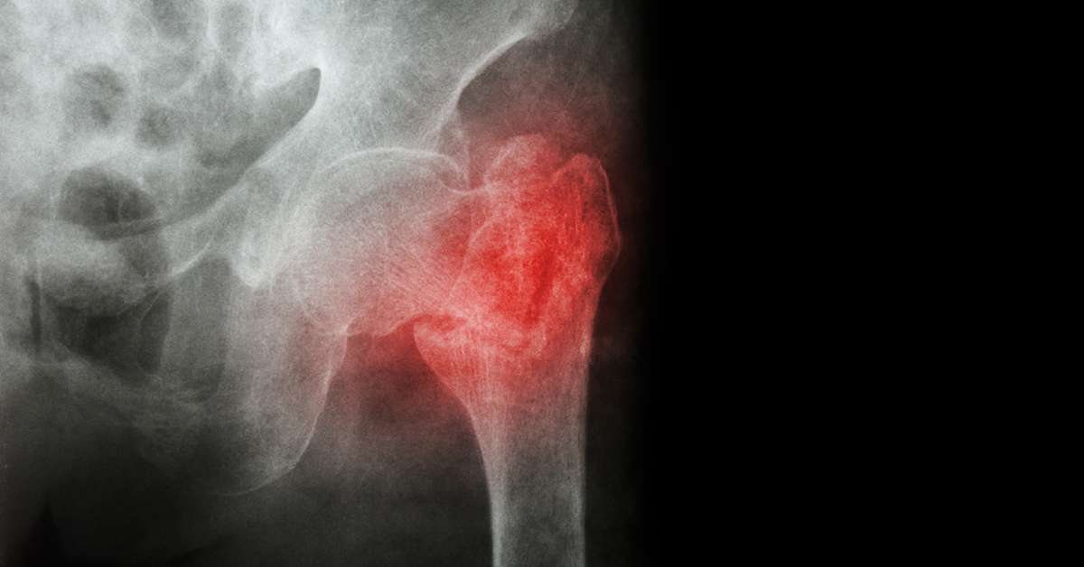 5 Common Hip Injuries