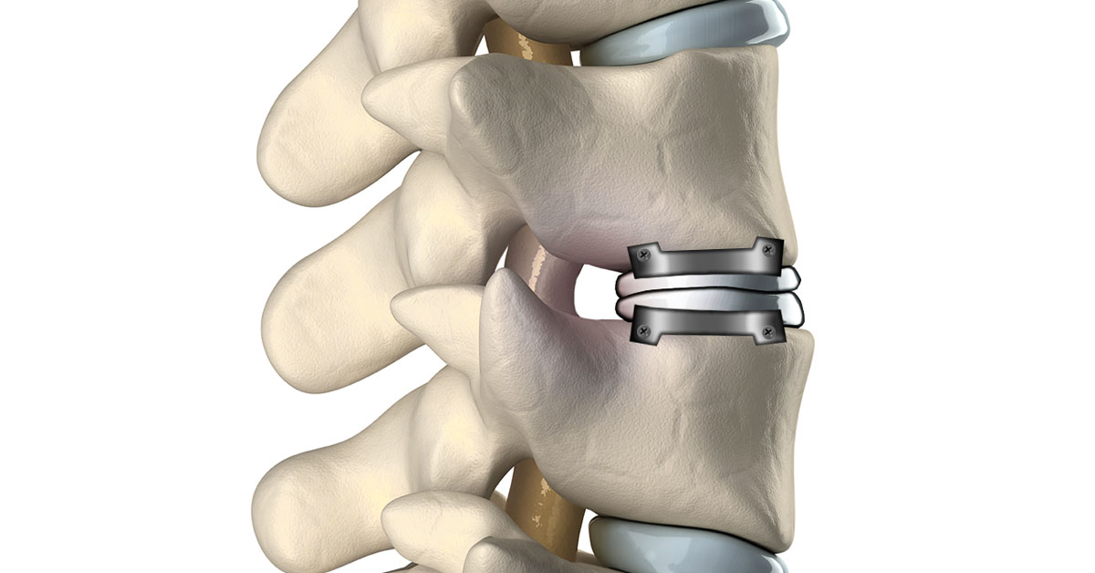 Cervical Artificial Disc Arthroplasty | Scottsdale, AZ Orthopedic Spine  Surgery