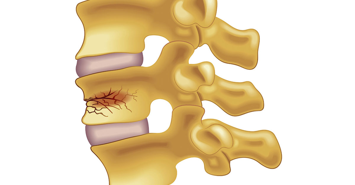 Figure 2 from Vertebral compression fractures in the elderly.