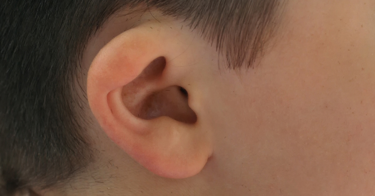 Congenital Ear Deformities