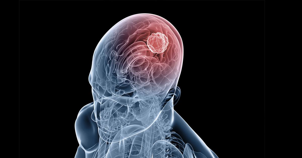 Craniotomy for the Treatment of Brain Tumors