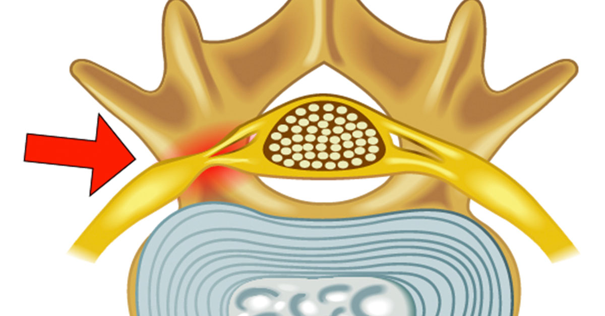 What Is Marked Spinal Stenosis