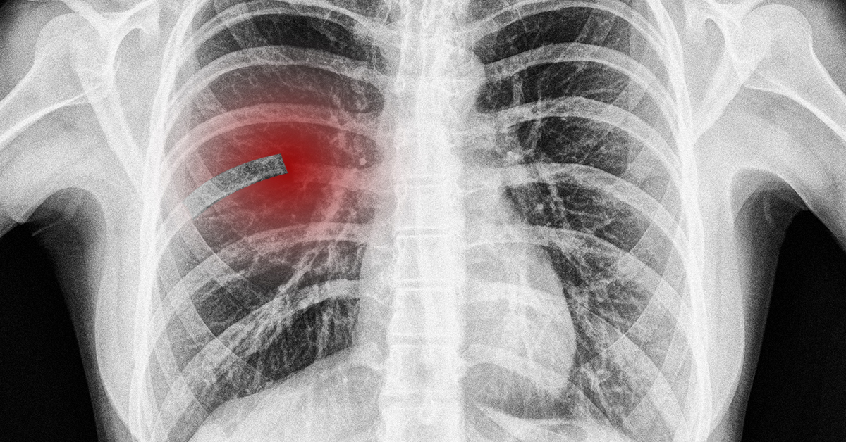 rib fracture symptoms