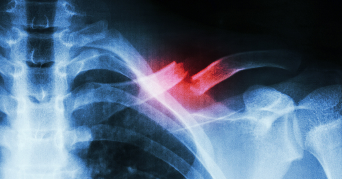 Fractures of the Shoulder