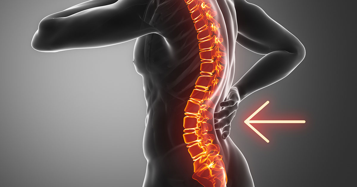 Lordosis - lumbar Information