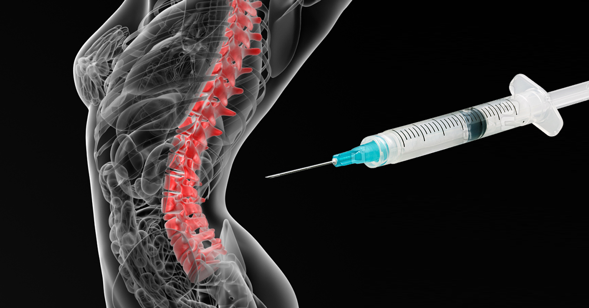 Lumbar Facet Injections for Back and Leg Pain