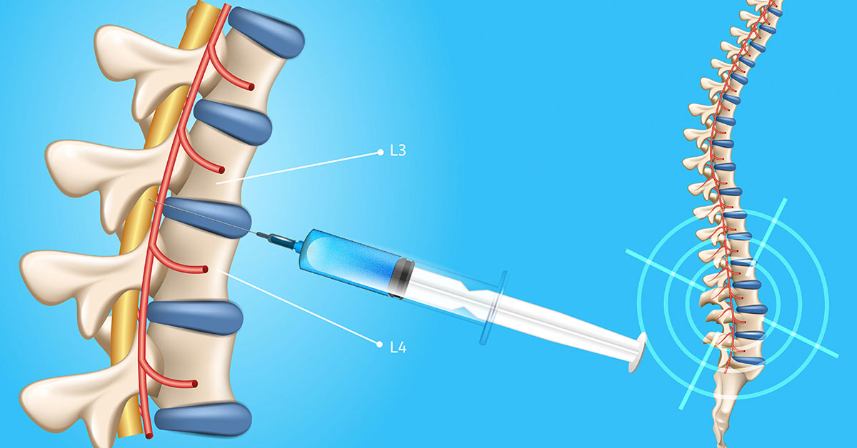 nerve pain after lumbar puncture