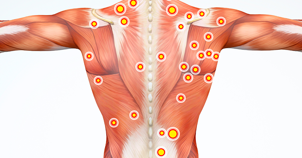 Myofascial Trigger Points and Back Pain - Propel Physiotherapy
