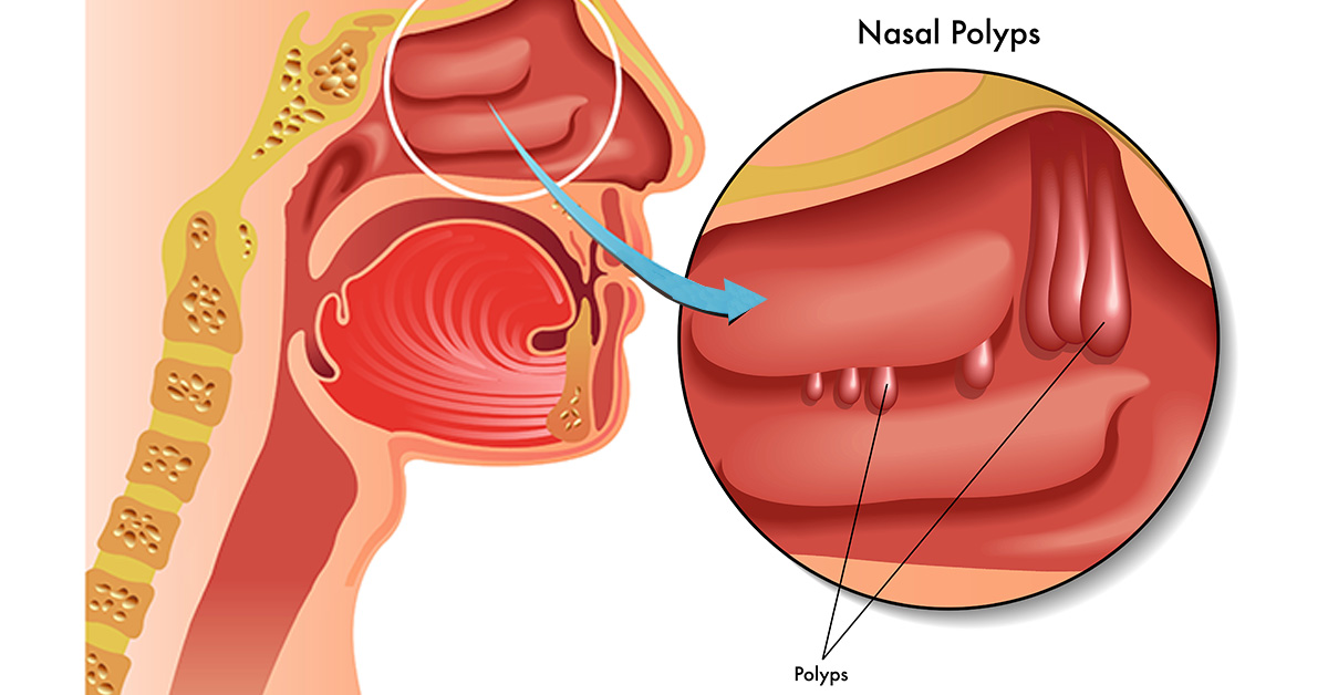 nasal-polyps-alabama-nasal-and-sinus-center-birmingham-al-ent