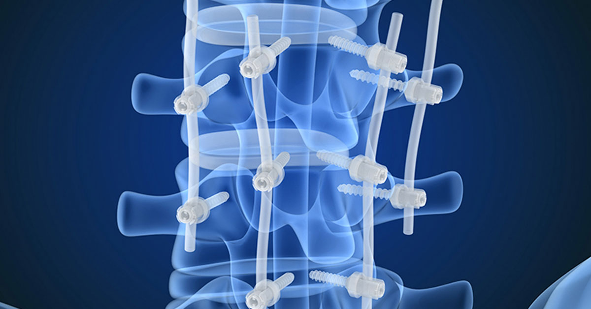 Posterior Lumbar Interbody Fusion