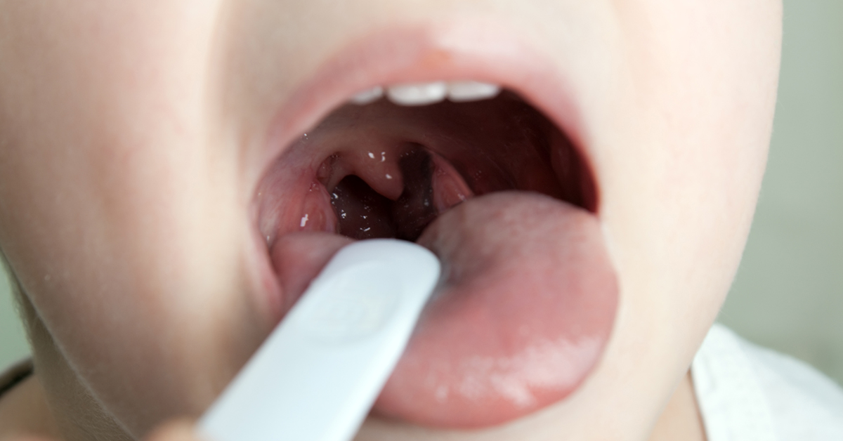 Should Your Child Have Their Tonsils Removed Alabama Nasal And Sinus 