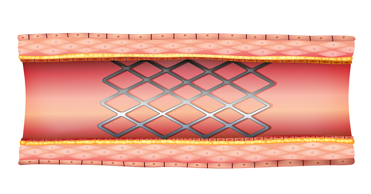 Sinus Stents - Alabama Nasal and Sinus Center, Birmingham, AL, ENT