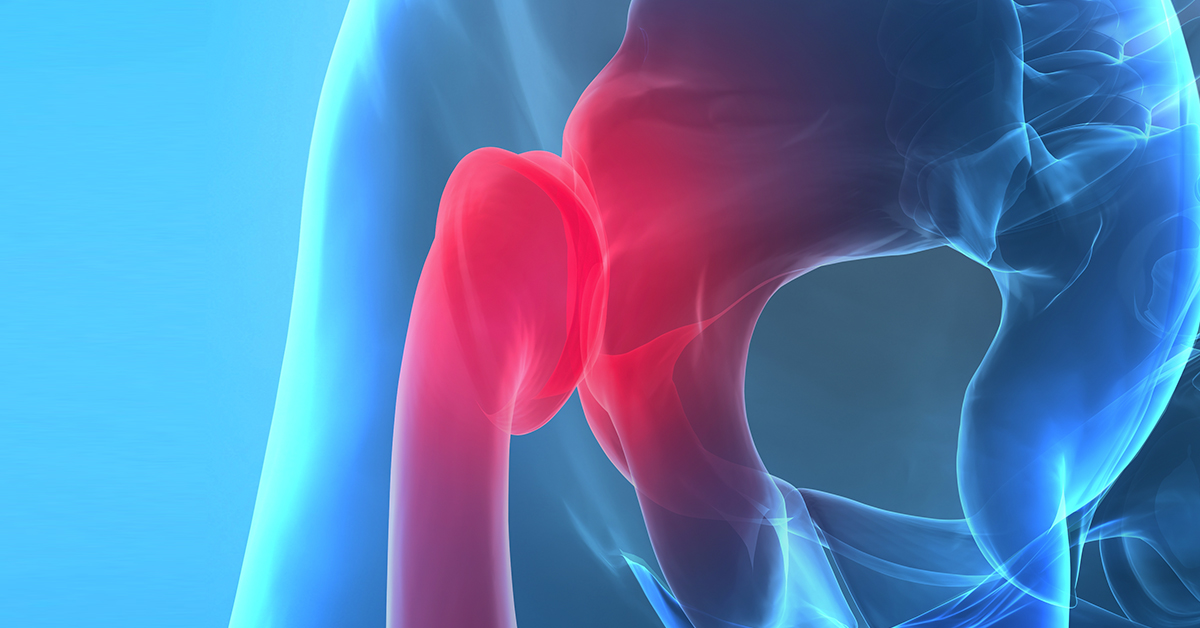 Snapping Hip Syndrome