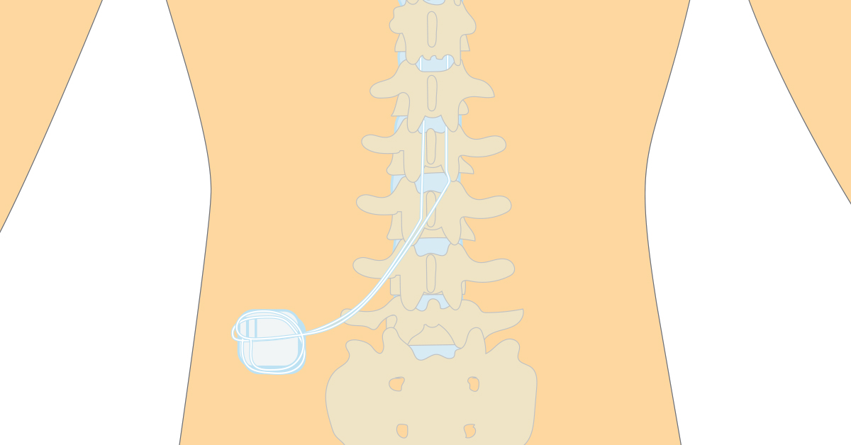 medtronic dorsal column stimulators