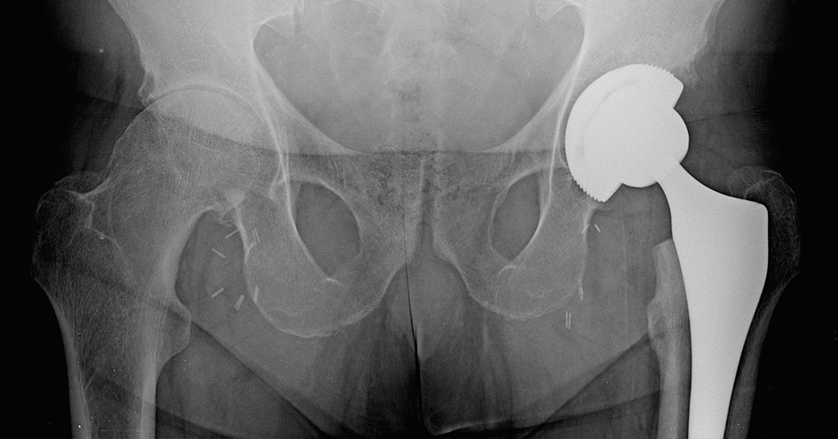 Total Hip Replacement Revision Surgery
