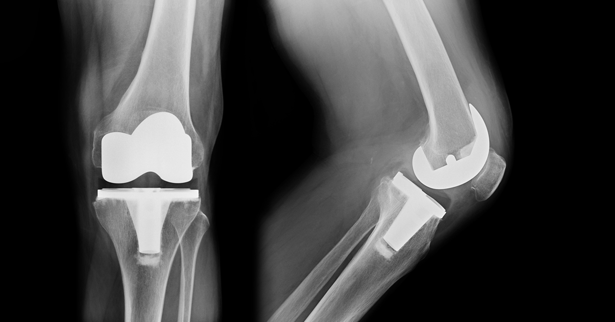 Total Knee Replacement Revision Surgery - New Iberia, LA - Orthopedic ...