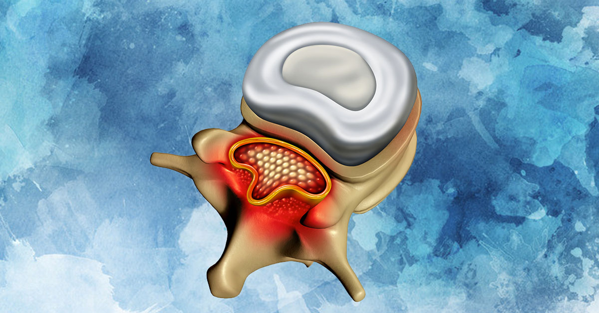 Spinal Stenosis