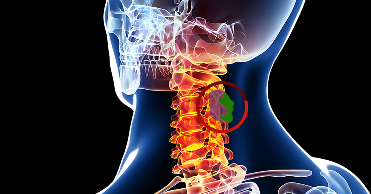 Spinal Tumors Atlanta GA Spine Surgery